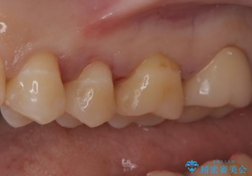 【セラミックインレー】虫歯の治療の治療後