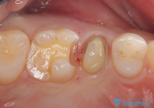 【セラミックインレー】定期検診にて虫歯を発見の治療中