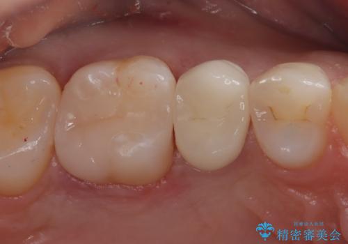 【セラミックインレー】定期検診にて虫歯を発見の症例 治療後