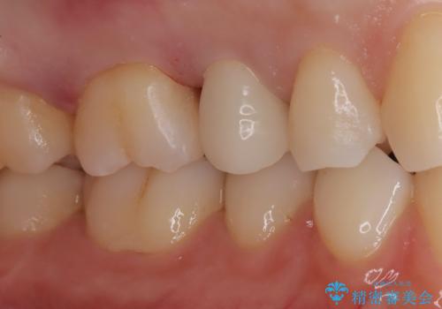 【セラミックインレー】定期検診にて虫歯を発見の治療後