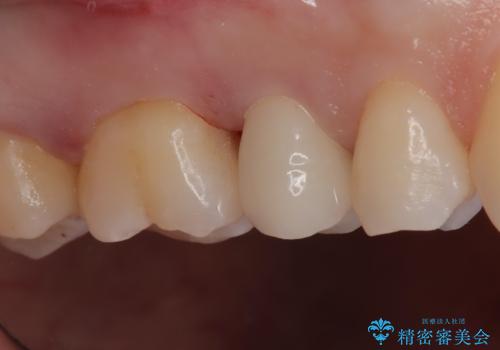 【セラミックインレー】定期検診にて虫歯を発見の治療後