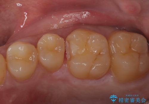 虫歯の再発リスクを減らすセラミックインレーの治療中