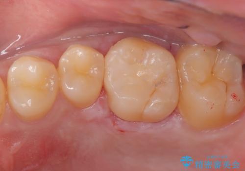 虫歯の再発リスクを減らすセラミックインレーの治療後