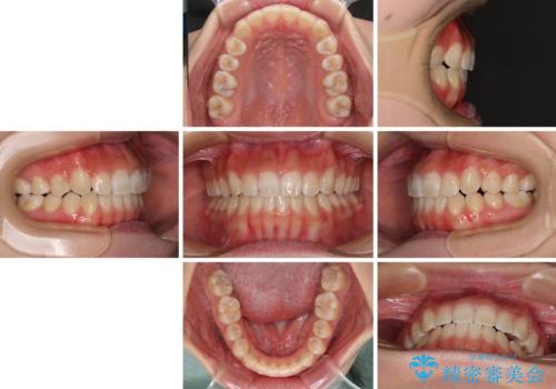 【モニター】上顎が狭い 急速拡大装置を用いたデコボコの解消の治療後