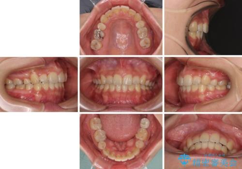 デコボコと膨らんだ口元 ハーフリンガルによる抜歯矯正とインプラント補綴治療の治療後