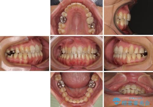 前歯の後戻り インビザラインでの再矯正治療の治療後