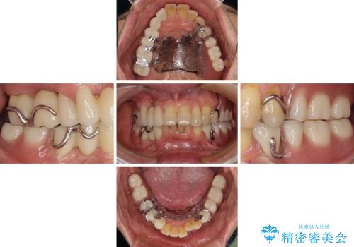 装着感の良い入れ歯を作りたい 金属床を使用した適合の良い部分床義歯の治療後