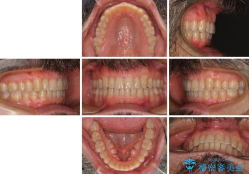 【モニター】前歯のデコボコを治したい インビザライン矯正治療の治療後