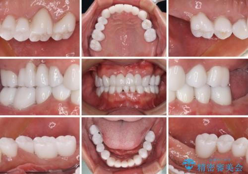 欠損と虫歯だらけの口の中 真っ白なセラミック治療の治療後