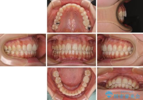 【モニター】隠れている下顎の前歯をインビザラインで改善の治療後