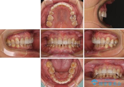 左右に骨格がずれて咬みにくい ワイヤー装置による抜歯矯正の治療後