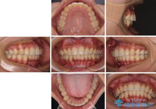 深い咬み合わせと前歯のデコボコ インビザラインによる矯正治療の治療後