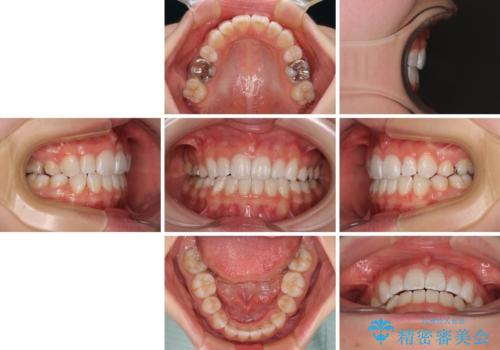 【モニター】口が閉じにくい 膨らんだ口元を抜歯矯正ですっきりとの治療後