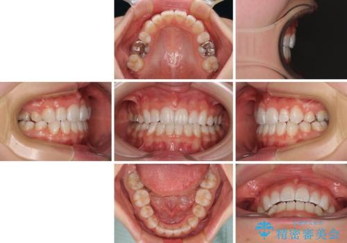 【モニター】口が閉じにくい　膨らんだ口元を抜歯矯正ですっきりとの治療後
