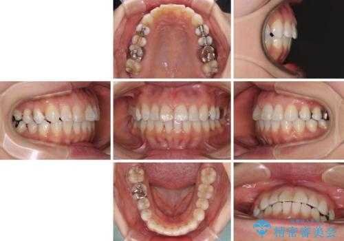 【モニター】前歯のデコボコを治したい インビザラインを用いた矯正治療の治療後