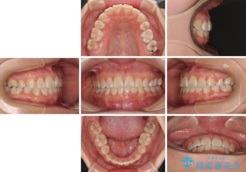 重度叢生と埋もれた奥歯 8本を抜歯したワイヤー矯正の治療後