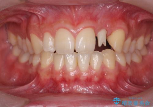 前歯部 インプラント治療の治療中