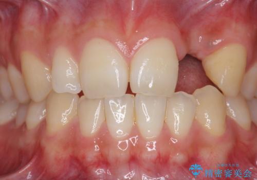 前歯部 インプラント治療の治療前