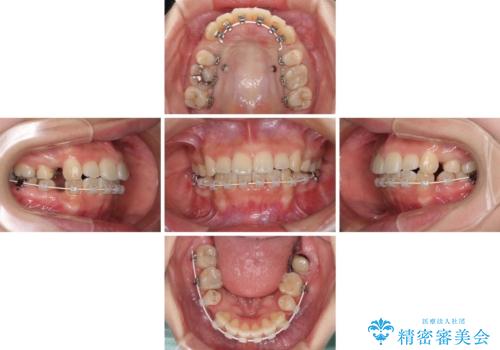 デコボコと膨らんだ口元 ハーフリンガルによる抜歯矯正とインプラント補綴治療の治療中