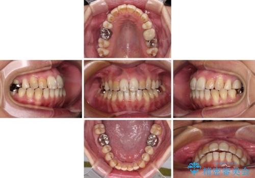 前歯の後戻り インビザラインでの再矯正治療の治療中