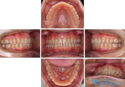 【モニター】前歯のデコボコを治したい インビザライン矯正治療の治療中