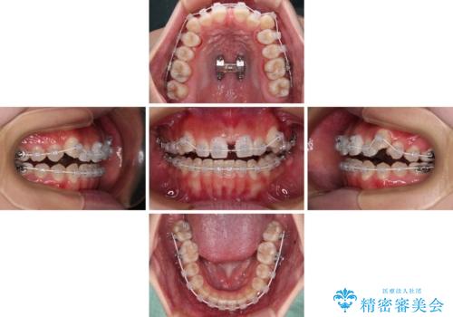 【モニター】上顎が狭い 急速拡大装置を用いたデコボコの解消の治療中