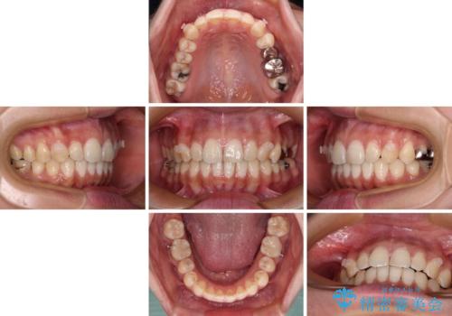 【モニター】隠れている下顎の前歯をインビザラインで改善の治療中