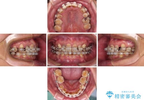 左右に骨格がずれて咬みにくい ワイヤー装置による抜歯矯正の治療中