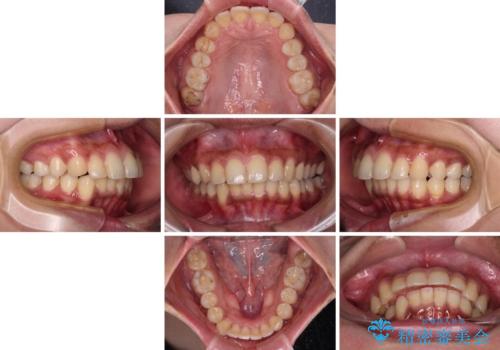 深い咬み合わせと前歯のデコボコ インビザラインによる矯正治療の治療中