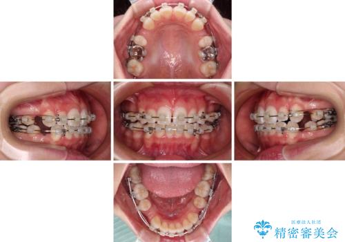 【モニター】口が閉じにくい 膨らんだ口元を抜歯矯正ですっきりとの治療中