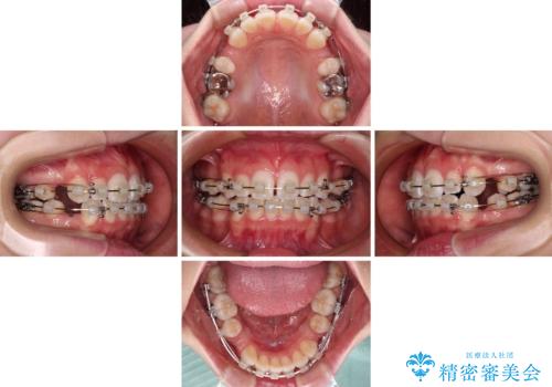 【モニター】口が閉じにくい　膨らんだ口元を抜歯矯正ですっきりとの治療中