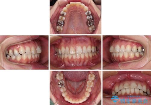 【モニター】前歯のデコボコを治したい インビザラインを用いた矯正治療の治療中