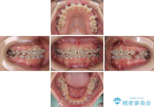 重度叢生と埋もれた奥歯 8本を抜歯したワイヤー矯正の治療中