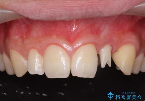 前歯部 インプラント治療の治療中
