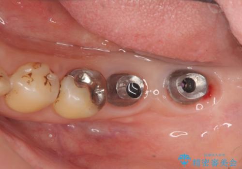 歯周病に対する全体治療の治療中
