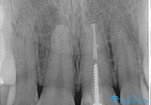 前歯の色が気になる【オールセラミッククラウン】の治療前