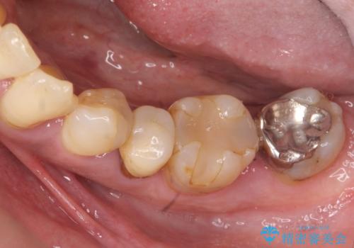 [ 重度歯周病 ] 骨造成・インプラント治療による咬合機能の回復の治療前