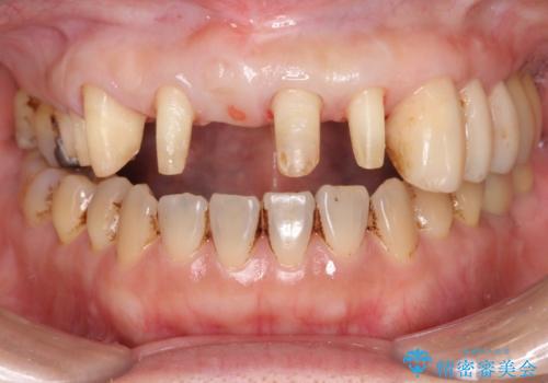 歯周病に対する全体治療の治療中