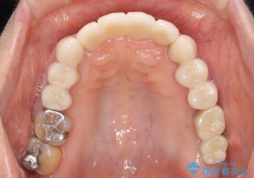 歯周病に対する全体治療の治療後