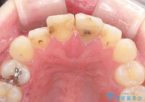 前歯の色が気になる【オールセラミッククラウン】の治療前