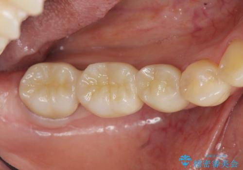銀歯の下に大きな虫歯の再発の治療後