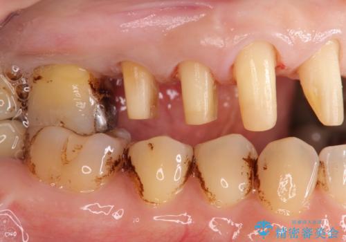 歯周病に対する全体治療の治療中