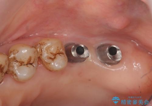 歯周病に対する全体治療の治療中