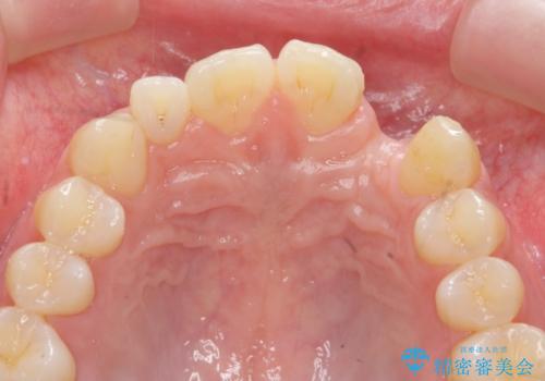 前歯部 インプラント治療の治療前