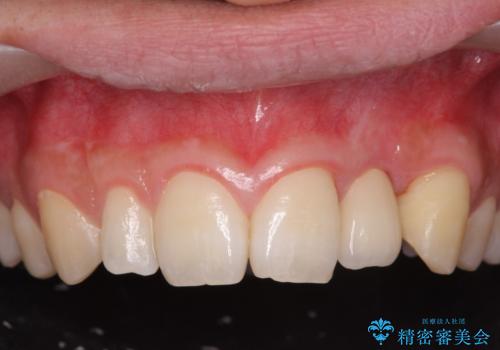 前歯部 インプラント治療の治療後