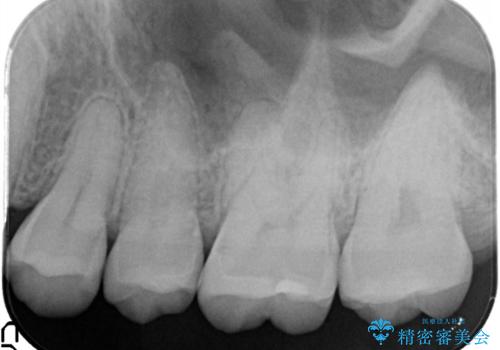 虫歯の再発リスクを減らすセラミックインレーの治療後