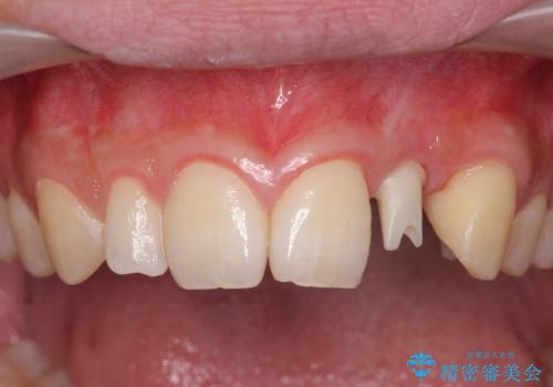 前歯部 インプラント治療の治療中