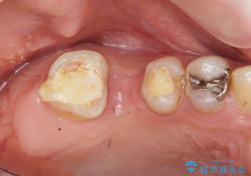 「 セラミック治療 」奥歯を白くしたいの治療前