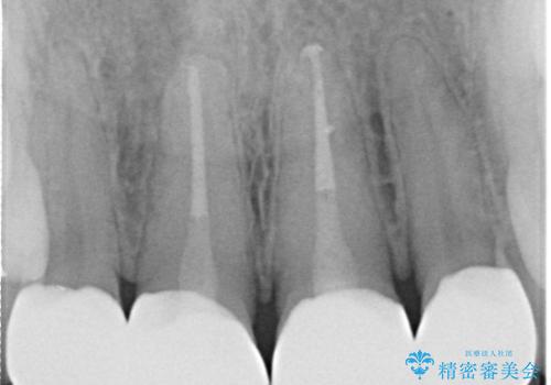 前歯の色が気になる【オールセラミッククラウン】の治療後