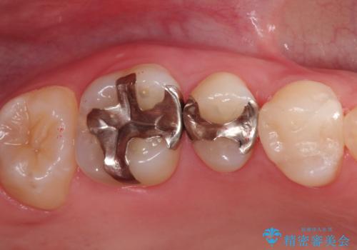 【セラミックインレー】メタルインレーの下が虫歯にの症例 治療前